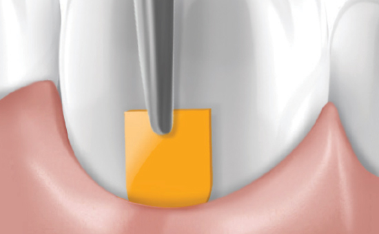 Dexcel Pharma – Periochip Relaunch Marketing